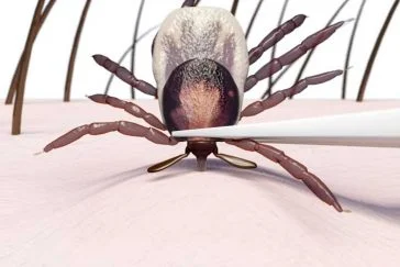 Tick Removal